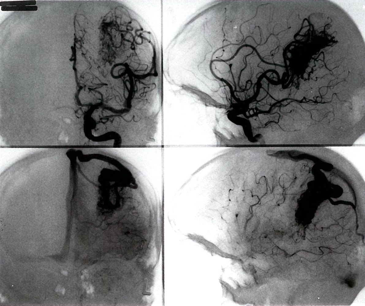Arteriovenous angioma (arteriovenous malformation)