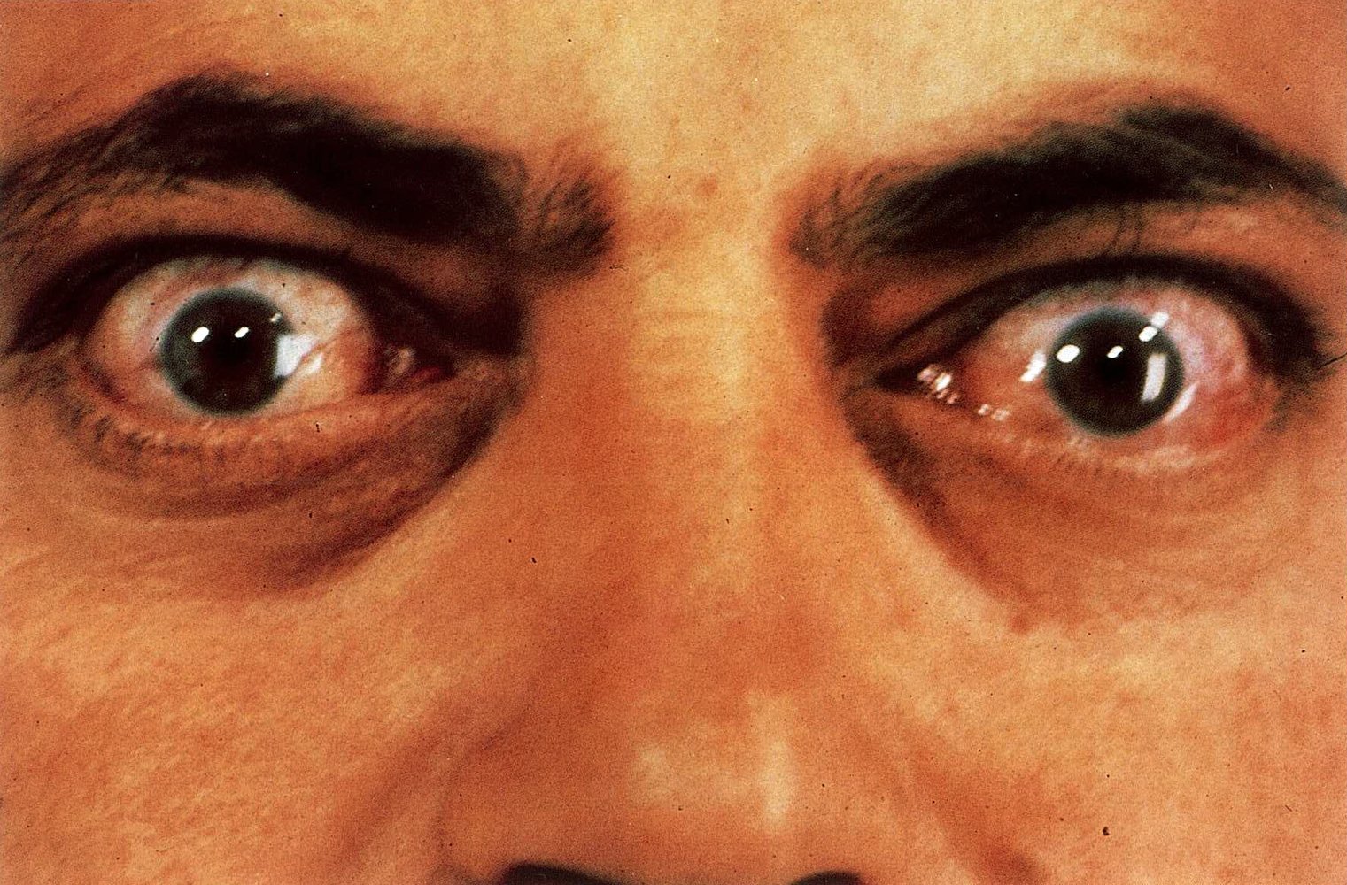 Graves ophthalmopathy