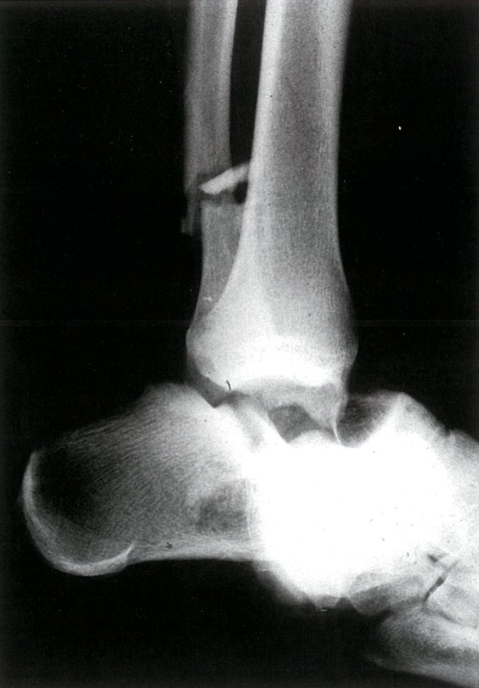 Complete talar dislocation and distal fibula fracture