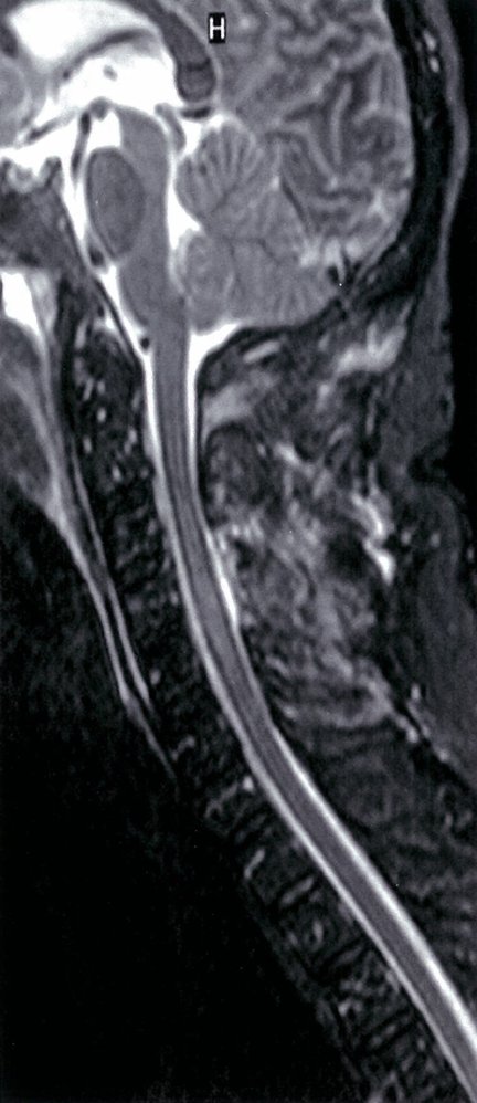 Myelopathy following a C4 fracture