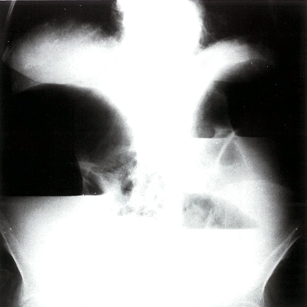 Mechanical obstruction of the large bowel