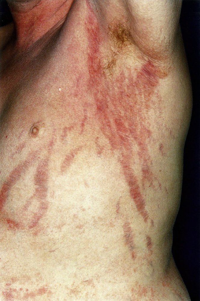 Stretch marks (striae)