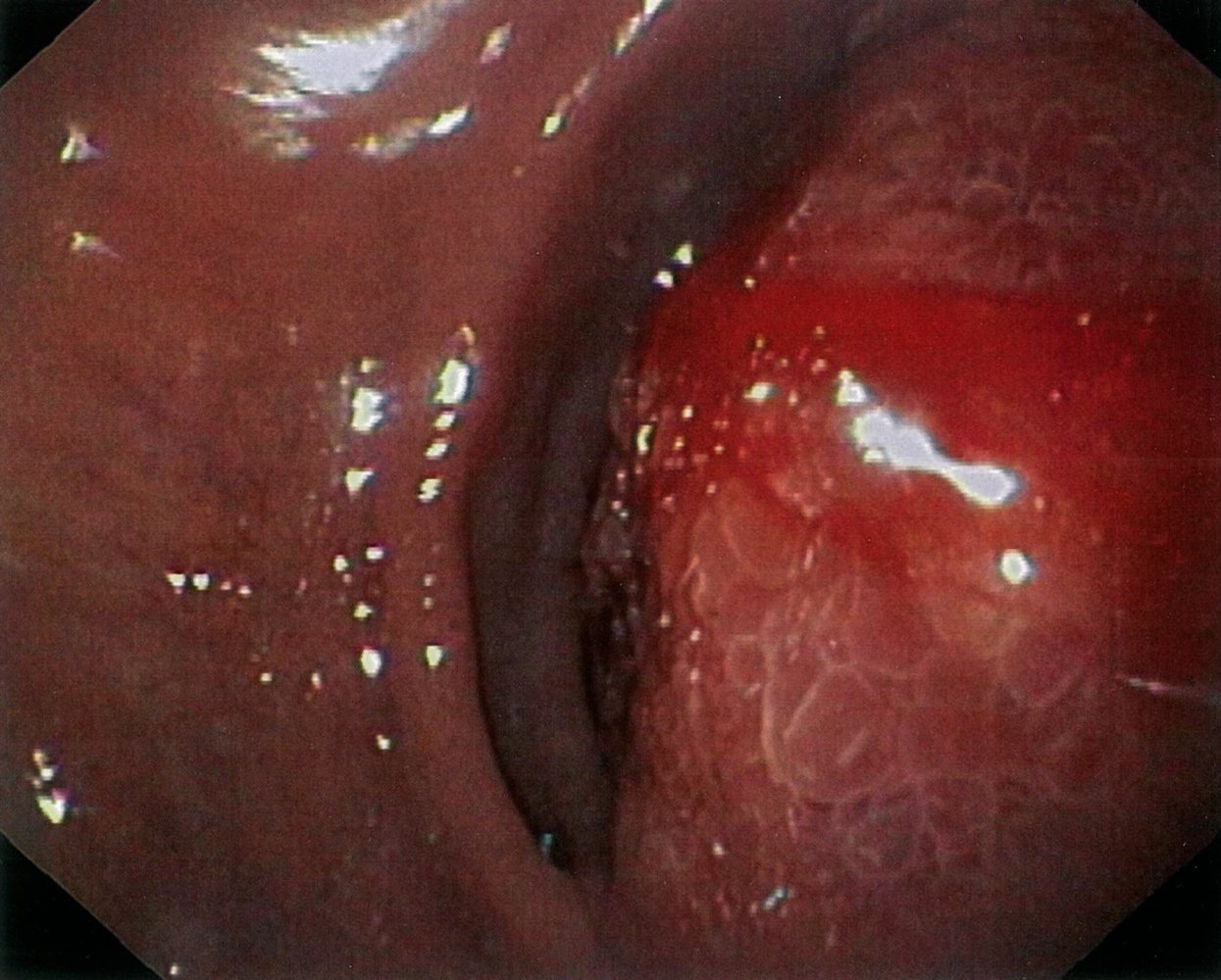 Duodenal obstruction by pancreatic pseudocyst