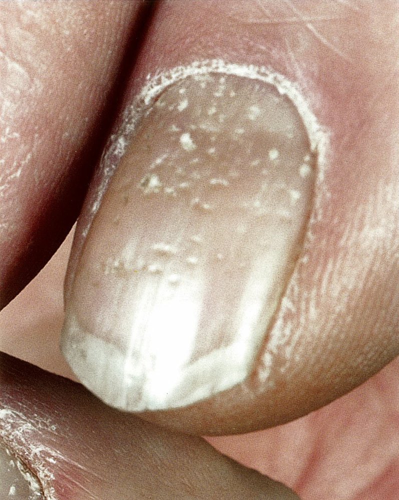 Nail pitting in psoriasis