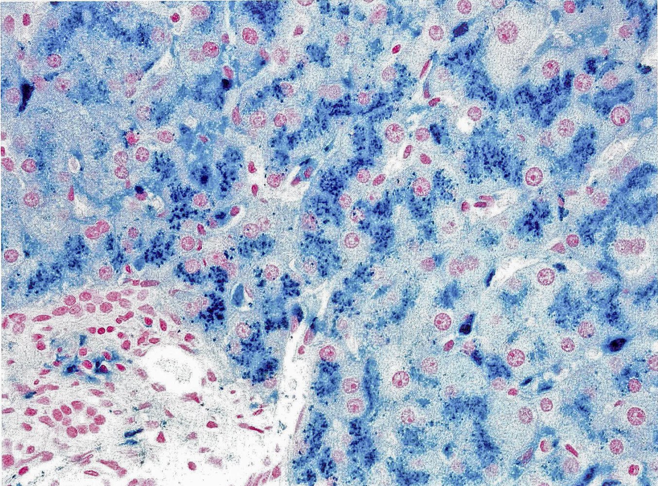 Hemochromatosis