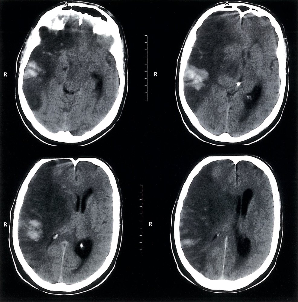 Subacute hemorrhagic cerebral infarct