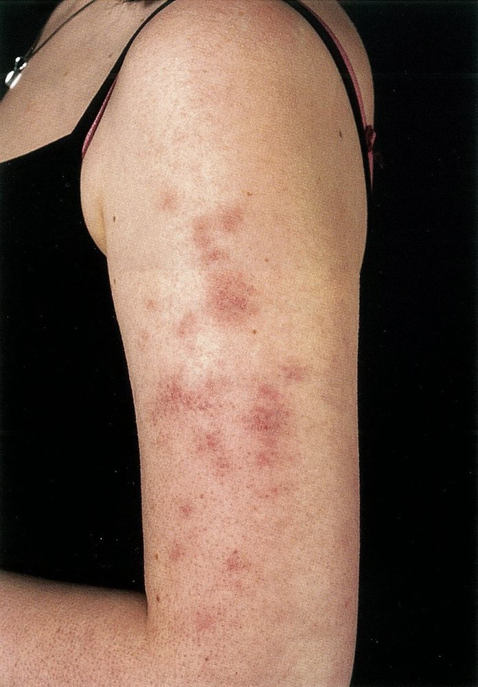 Macular rash in systemic lupus erythematosus