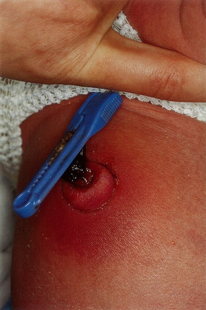 Omphalitis in a newborn