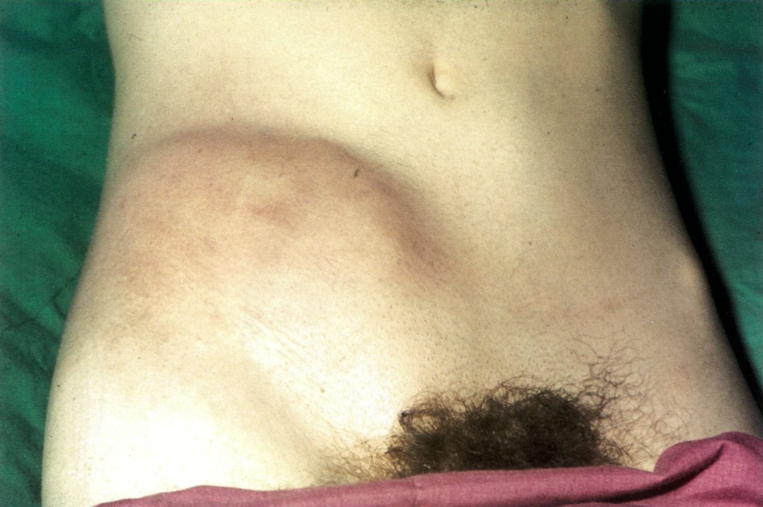 Abdominal mass secondary to Crohn disease