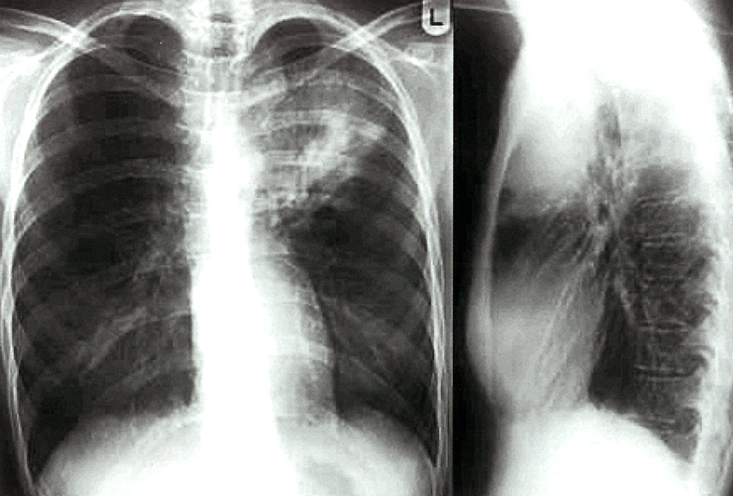 Pulmonary tuberculosis in the left upper lobe