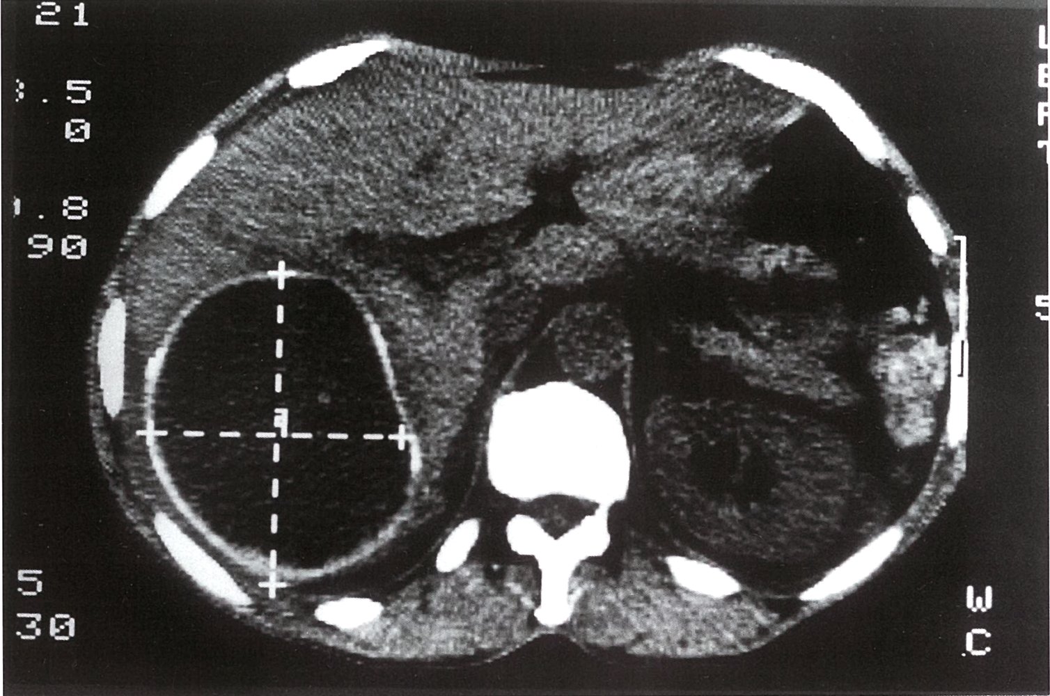 Hepatic cyst in hydatid disease