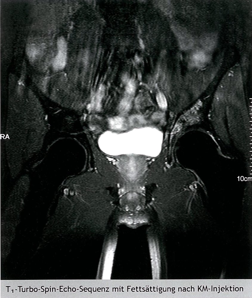 Chondrosarcoma of the left acetabulum (grade 1)