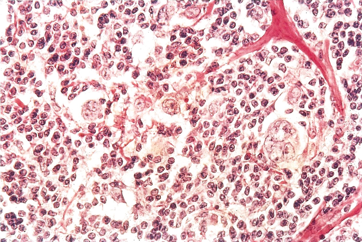 Hodgkin lymphoma
