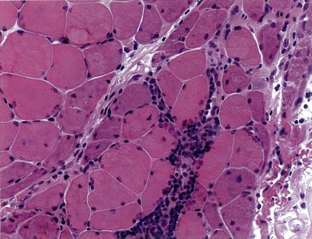 Dermatomyositis