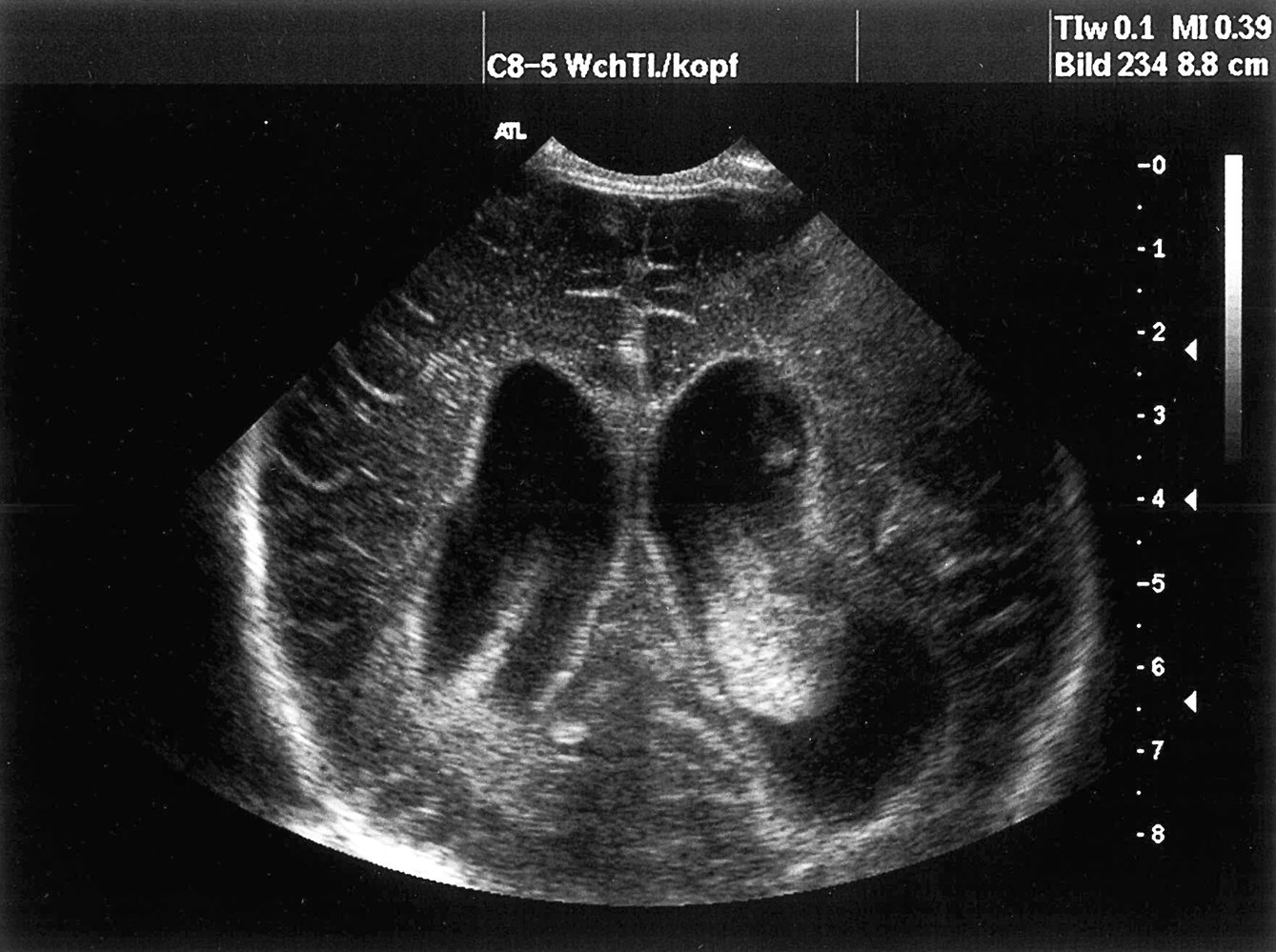 Congenital CMV infection
