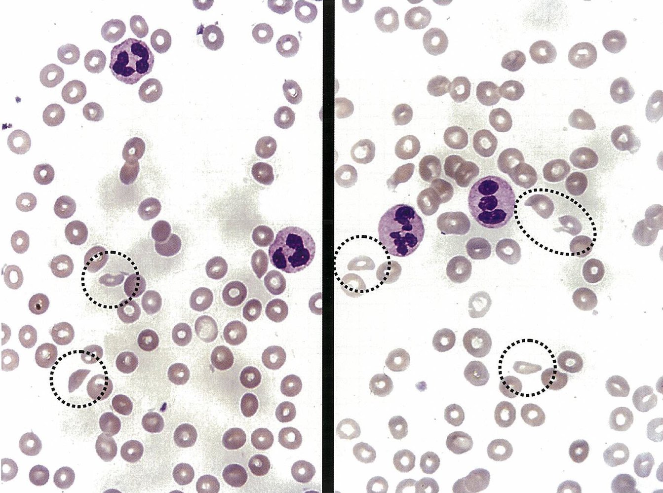 Schistocytes in hemolytic uremic syndrome