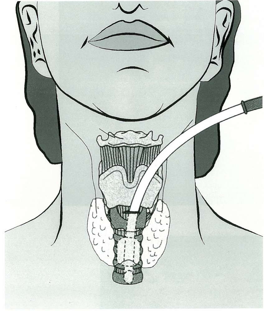 Cricothyroidotomy
