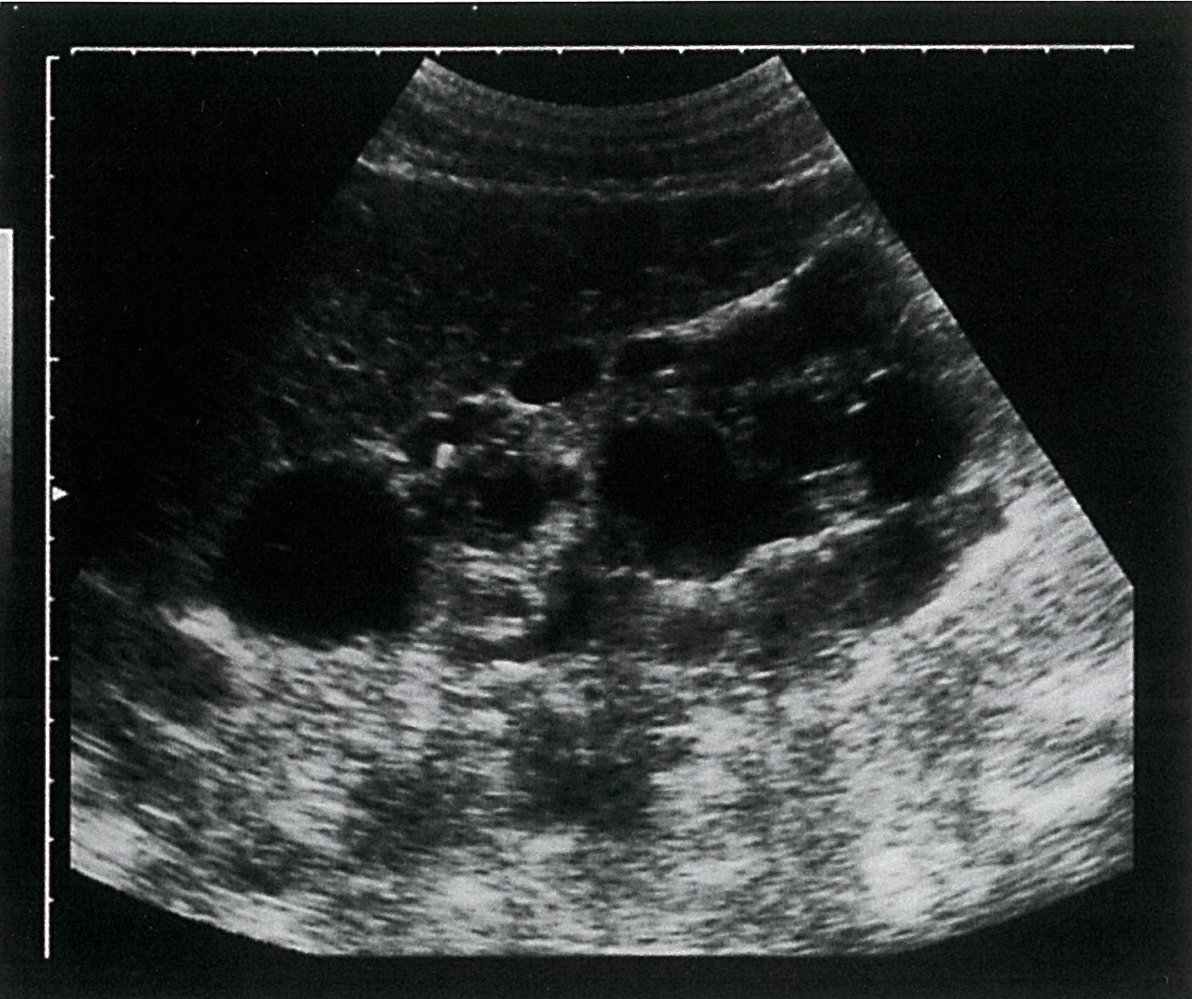 Autosomal dominant polycystic kidney disease (ADPKD)
