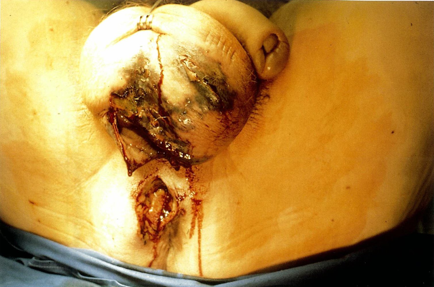 Fournier gangrene