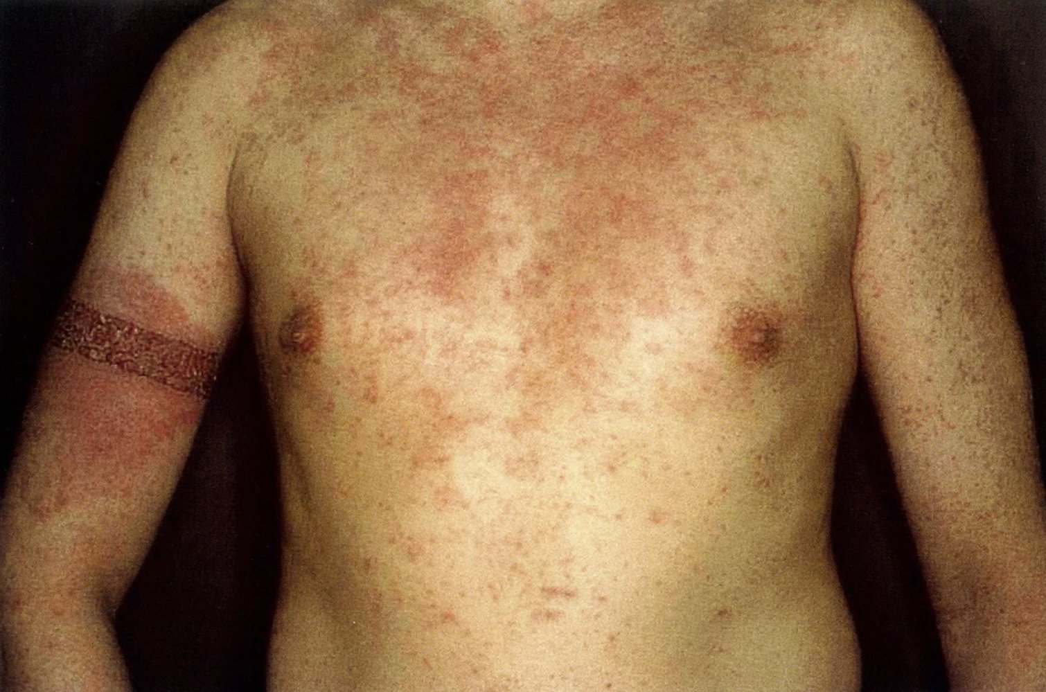Allergic contact dermatitis