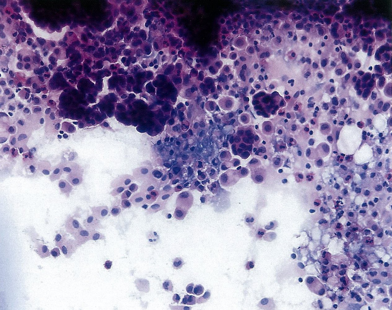 Malignant pleural effusion secondary to ovarian cancer