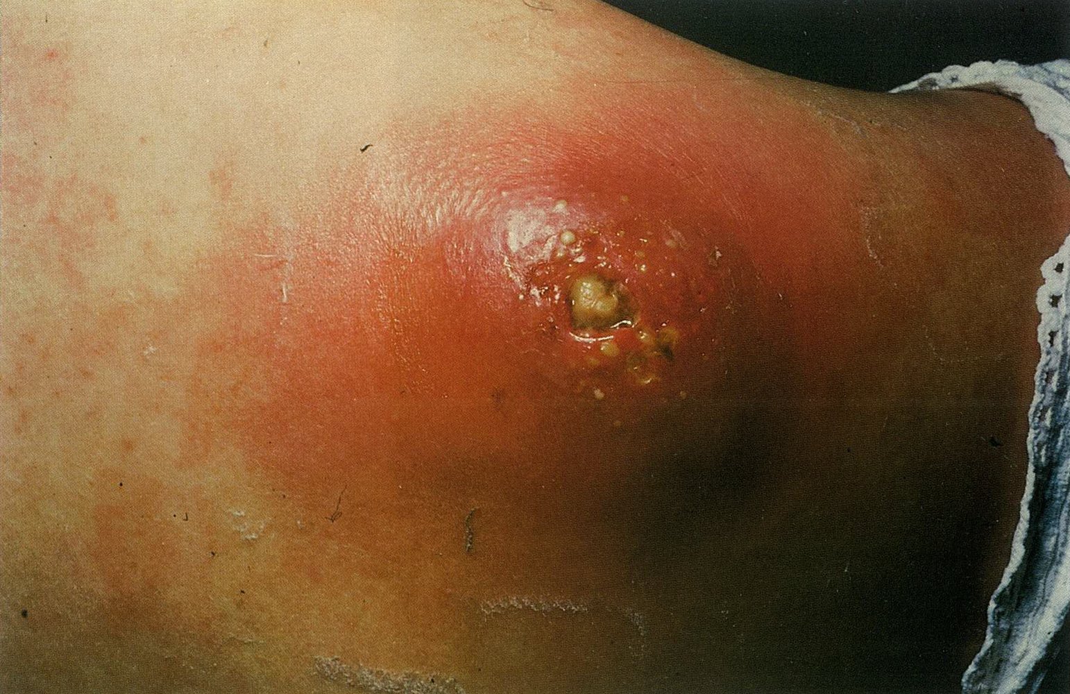 Carbuncle
