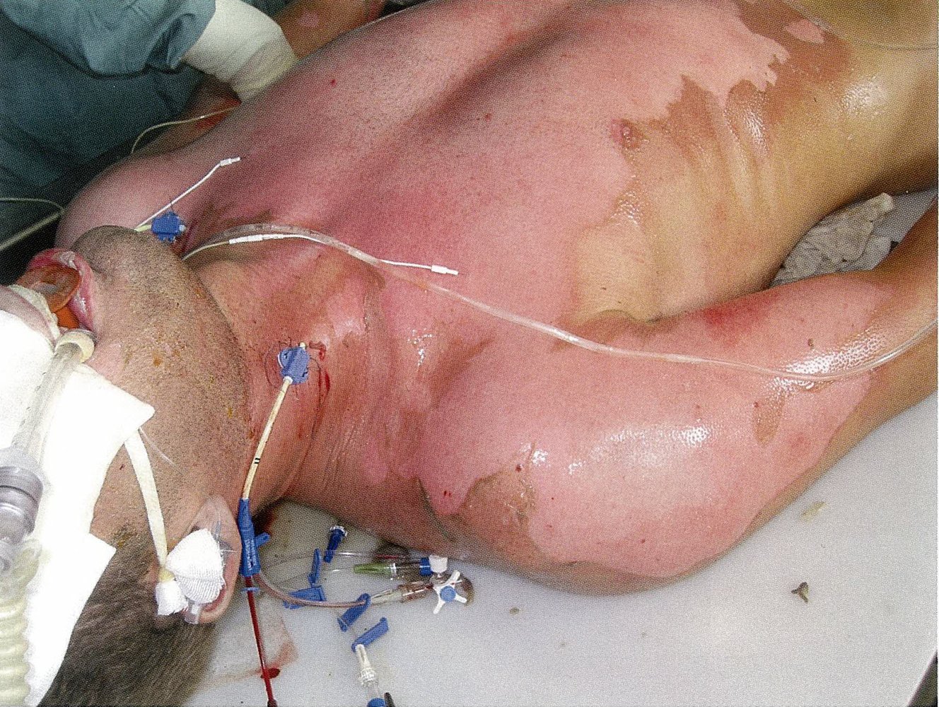 Second-degree electrical burn