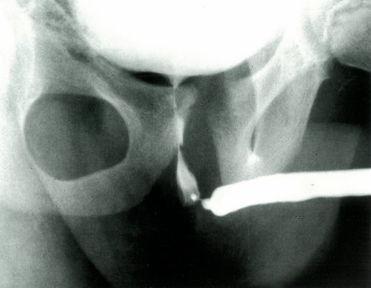 Retrograde urethrogram with urethral stricture