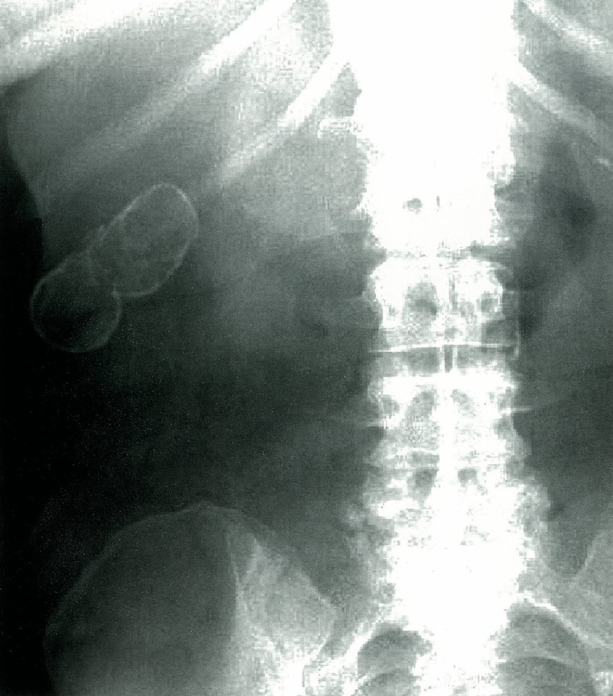 Porcelain gallbladder