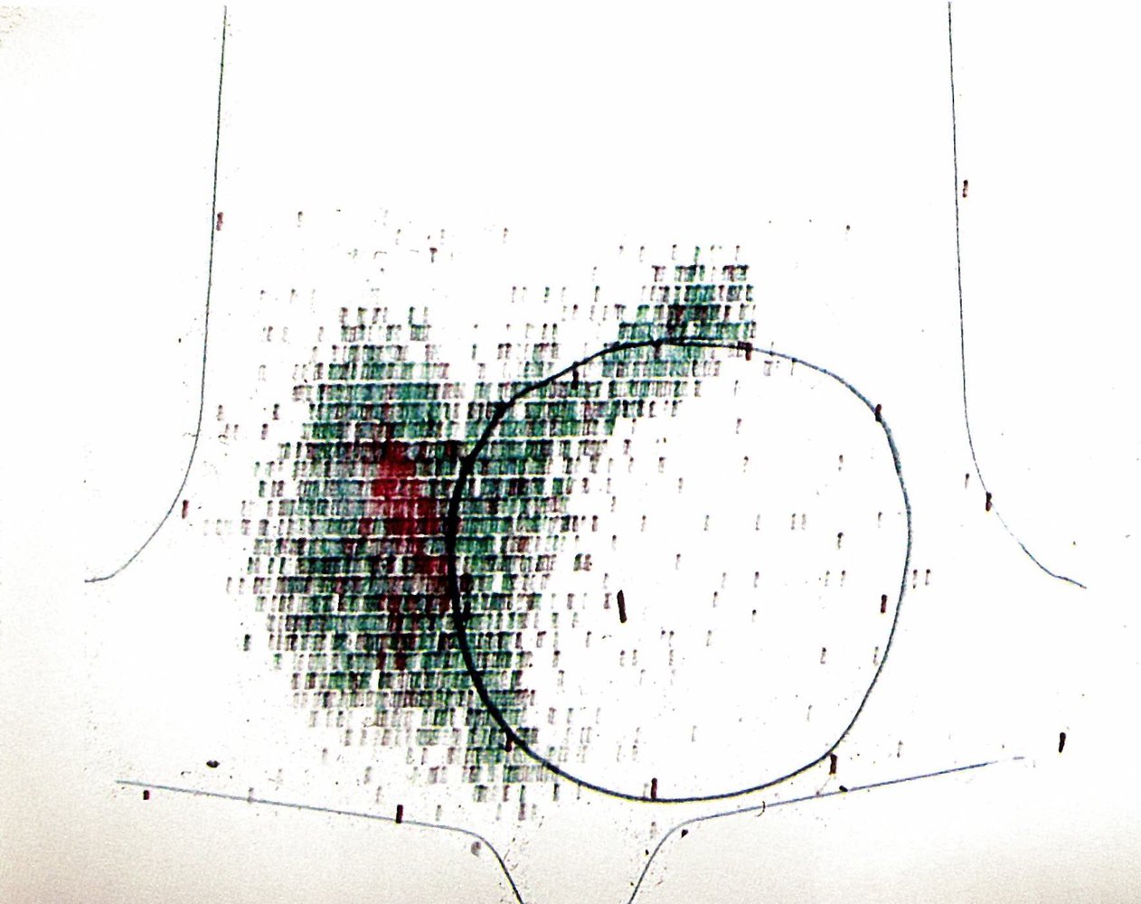 Cold nodule on thyroid scintigraphy