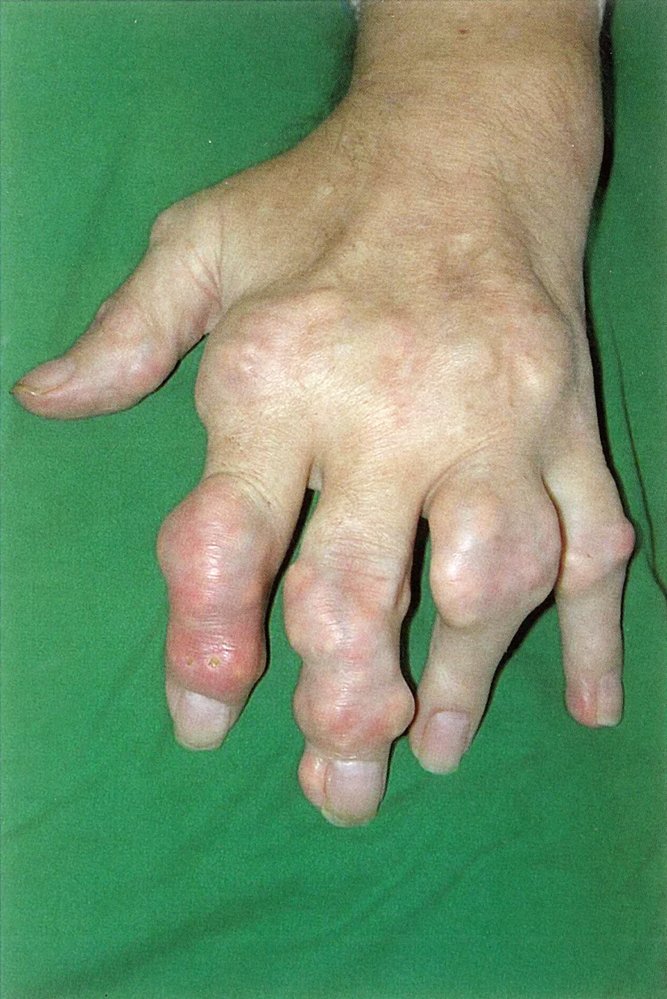 Gouty tophi