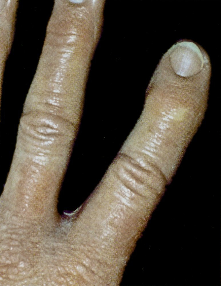 Heberden node