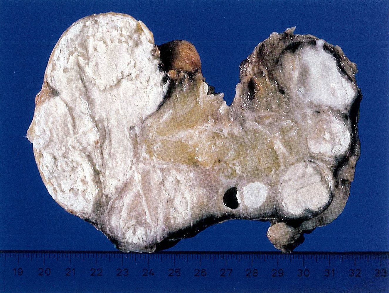 Putty kidney in urogenital tuberculosis