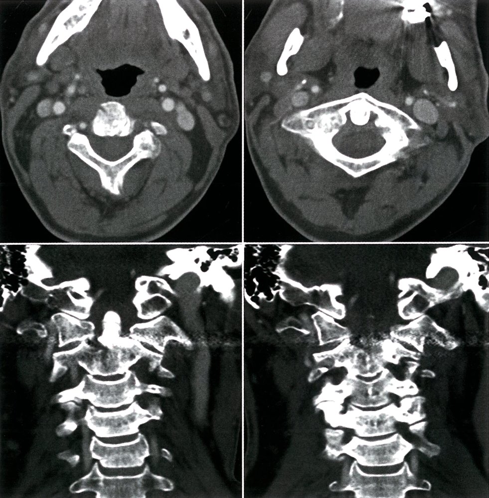 Stenosis of the vertebral artery at C1-C2
