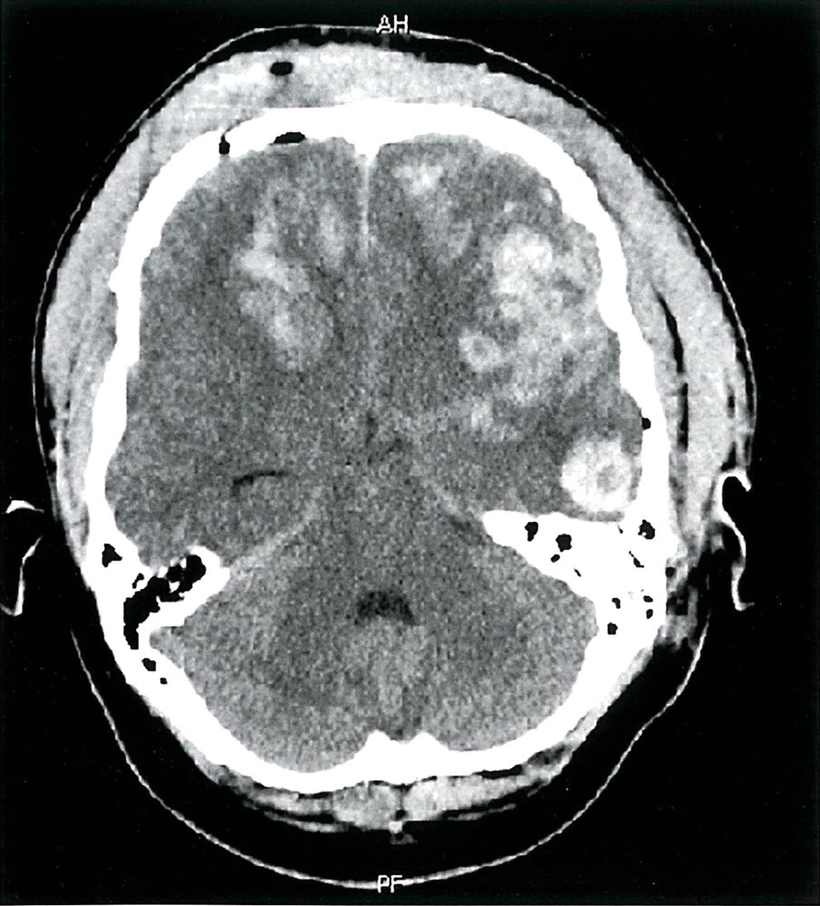Traumatic intracerebral hemorrhage