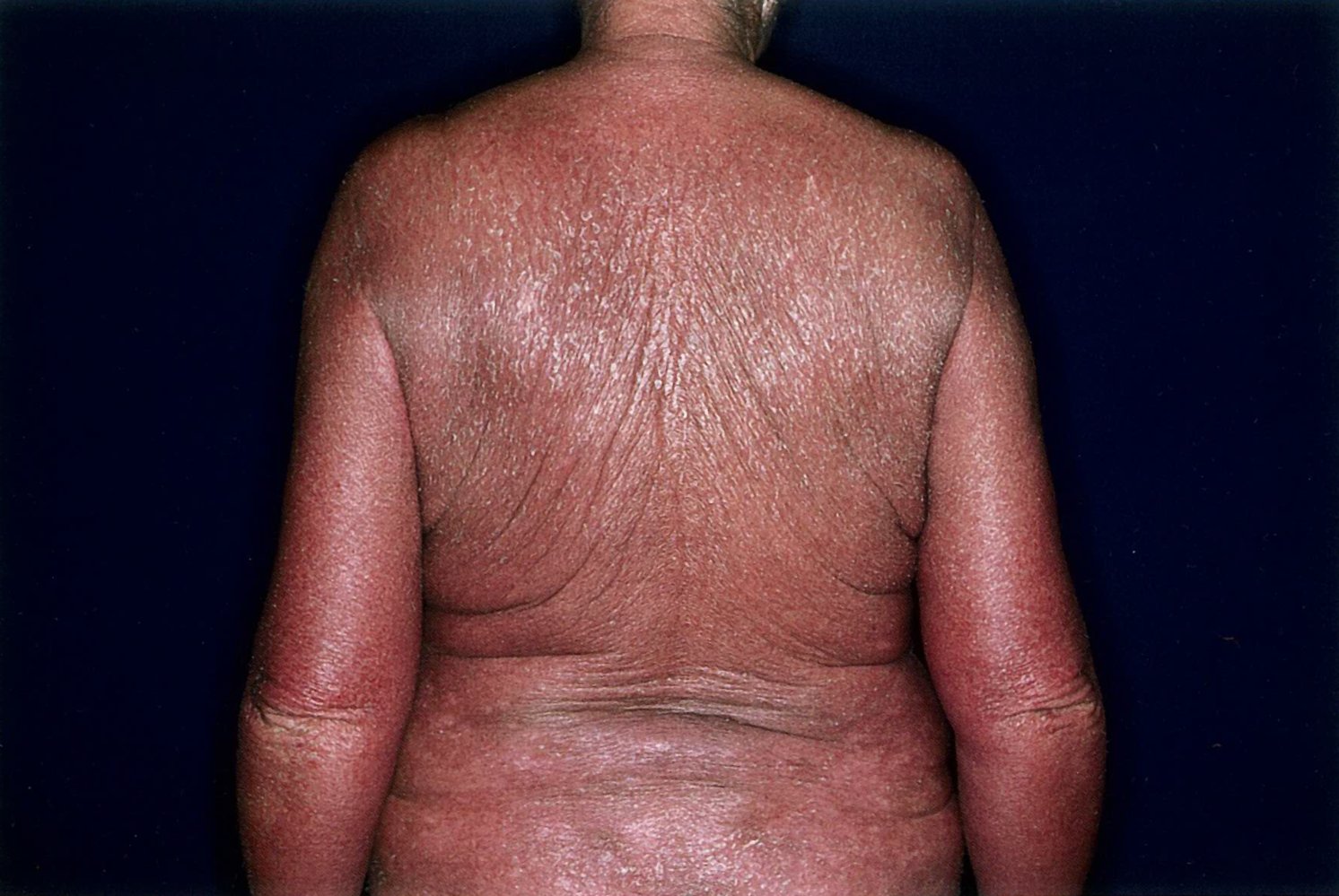 Erythroderma