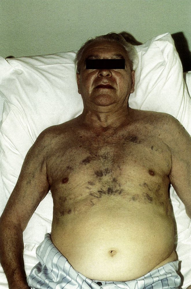 Superior vena cava obstruction