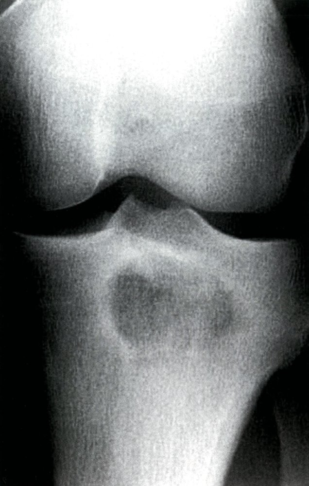 Lytic lesion in long bone from subacute osteomyelitis