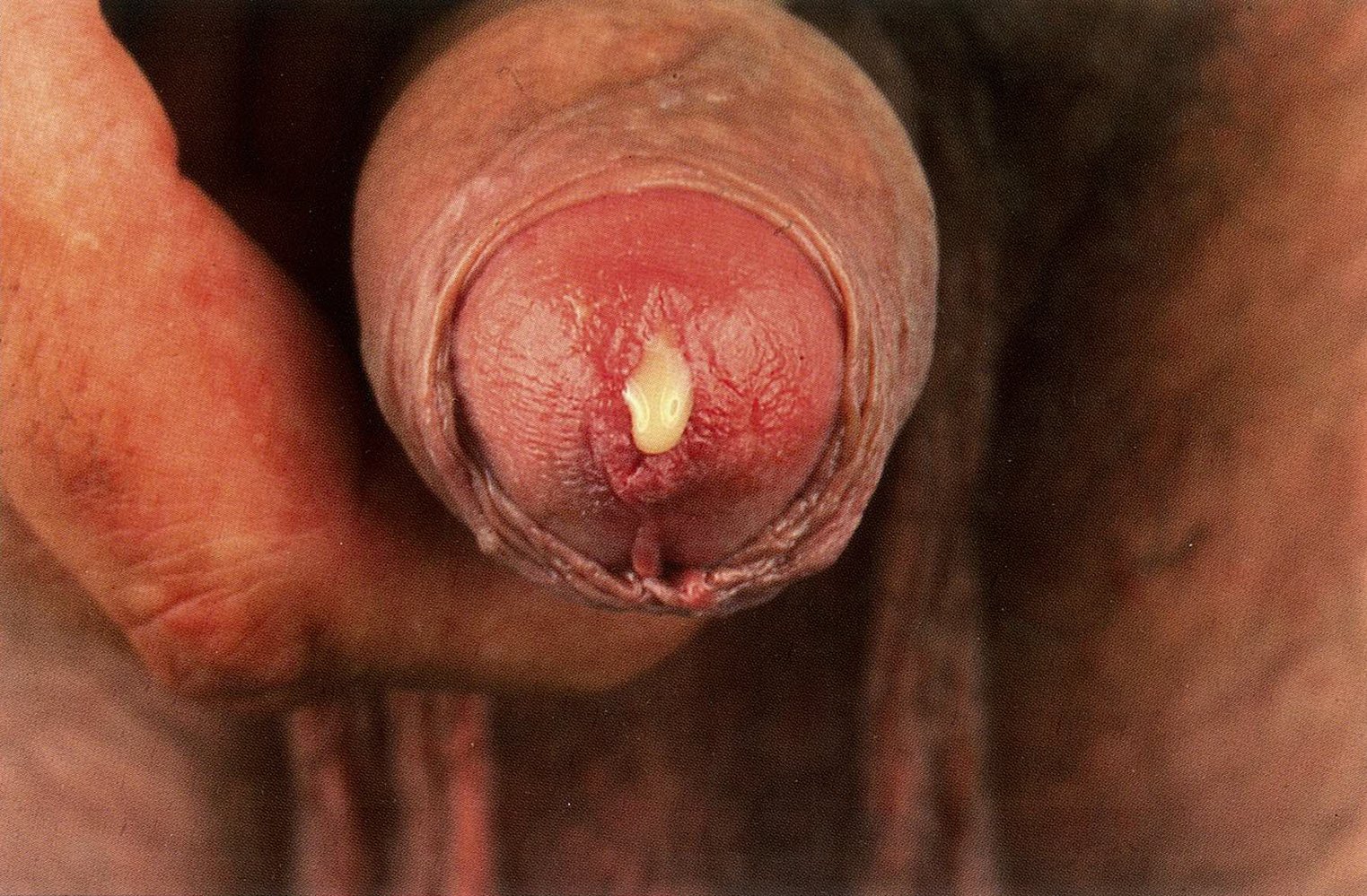 Purulent urethral discharge