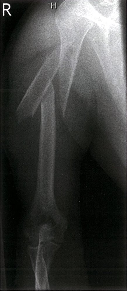 Humerus fracture
