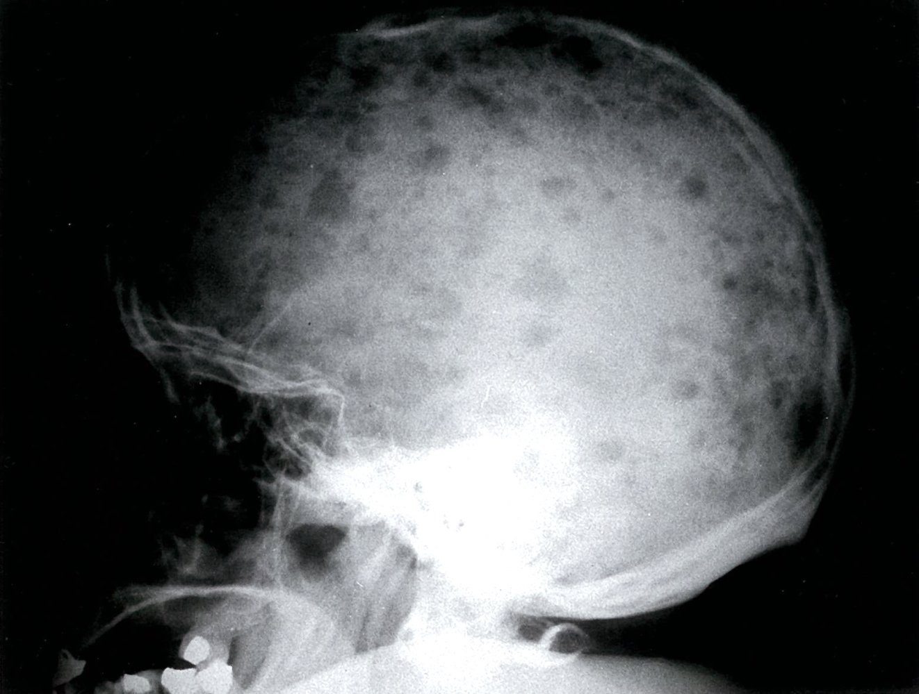 Lytic calvarial lesions in multiple myeloma