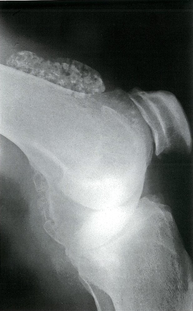 Synovial chondromatosis