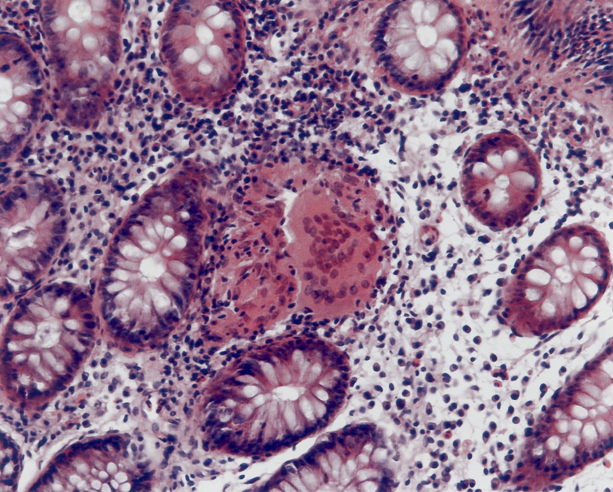 Crohn disease