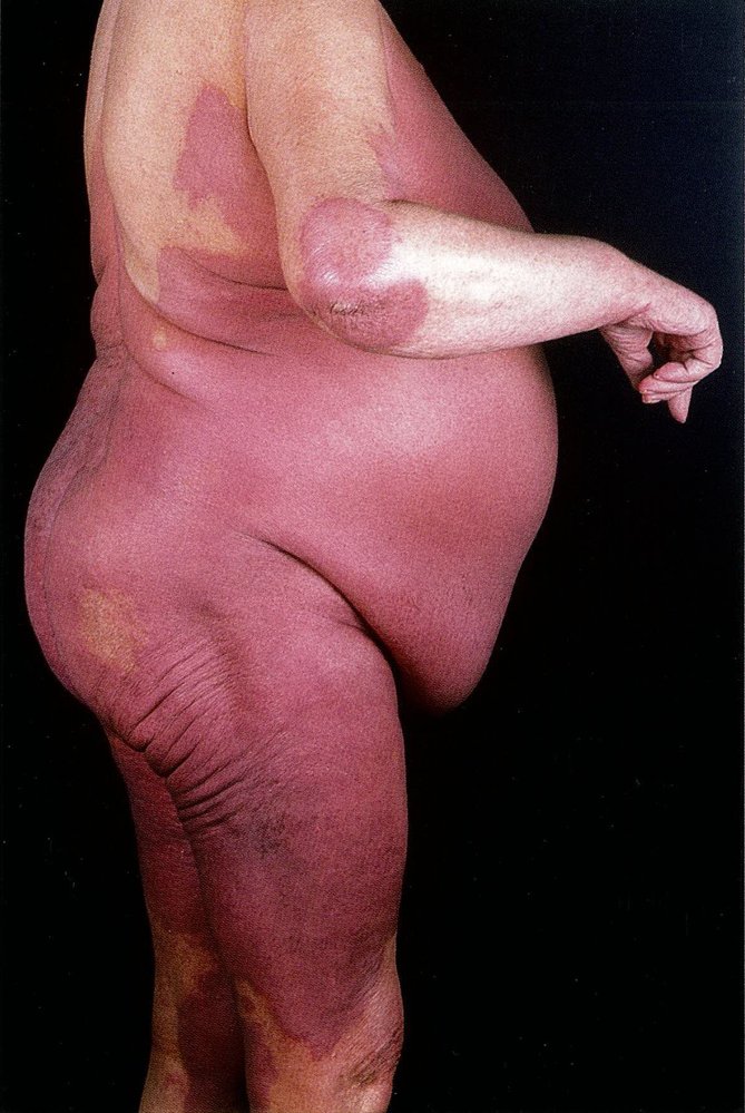 Erythroderma
