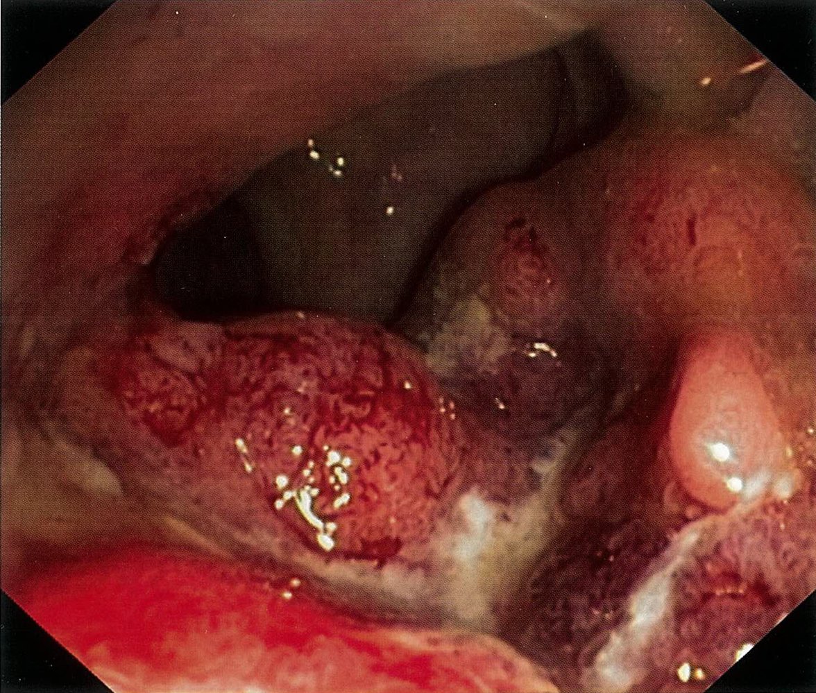 Rectal cancer