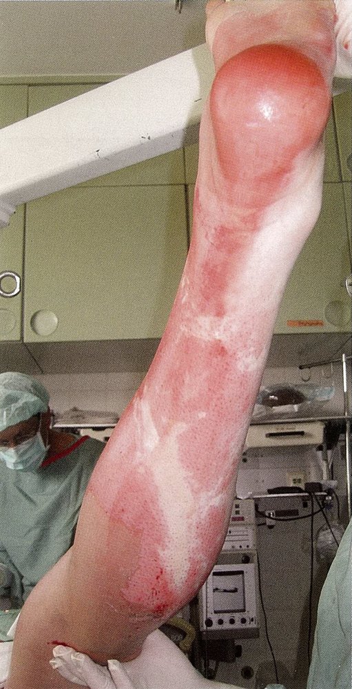Electrical burns