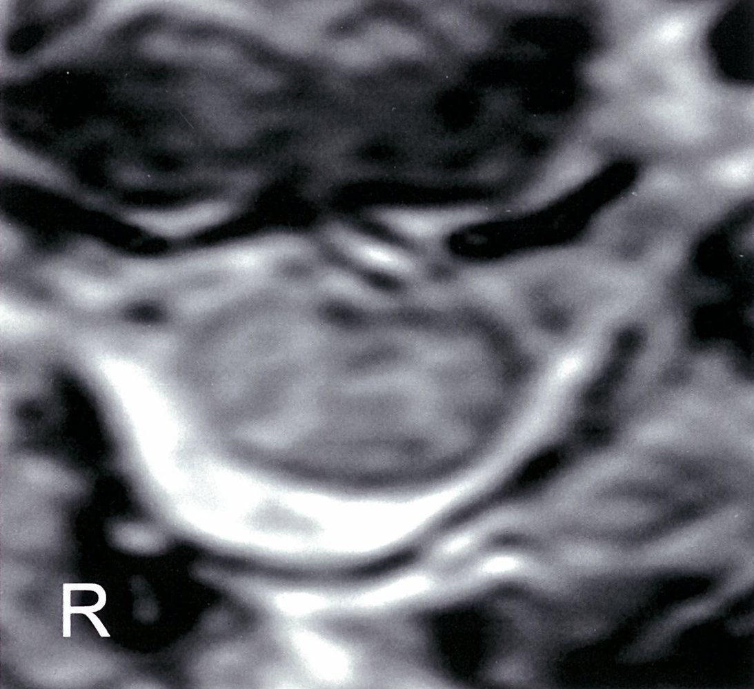 Myelopathy after a vertebral body fracture