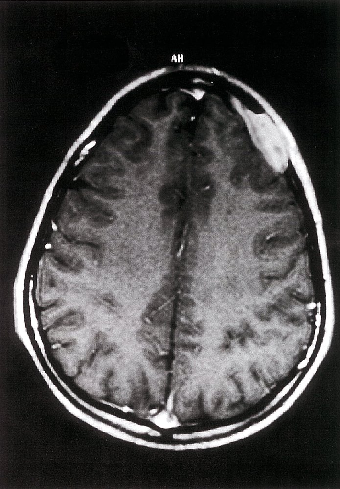 Langerhans cell histiocytosis