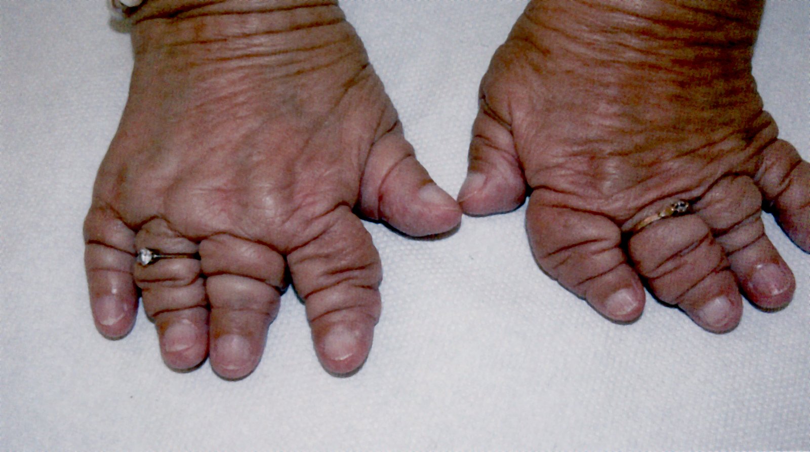 Telescoping fingers (arthritis mutilans)