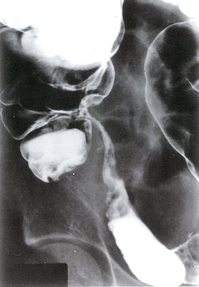 Stricture of the terminal ileum